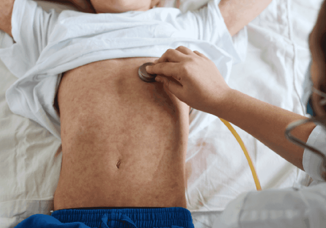 ה-WHO וה-CDC הכריזו על החצבת כ"איום ממשי" על העולם - ומאשימים את הקורונה 