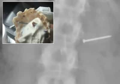 פלורידה: ביס מגלידה הסתיים בפיצוי של 14 מיליון דולר