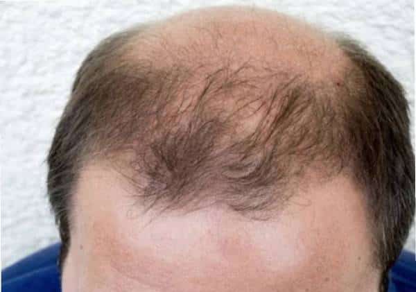 לא רק התקרחות: טבלת דירוג 50 התסמינים הנפוצים של נגיף הקורונה נחשפת