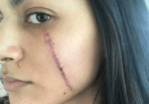 תקיפה מזעזעת בברוקלין: אמר "את יפה", וחתך את הצעירה בפניה