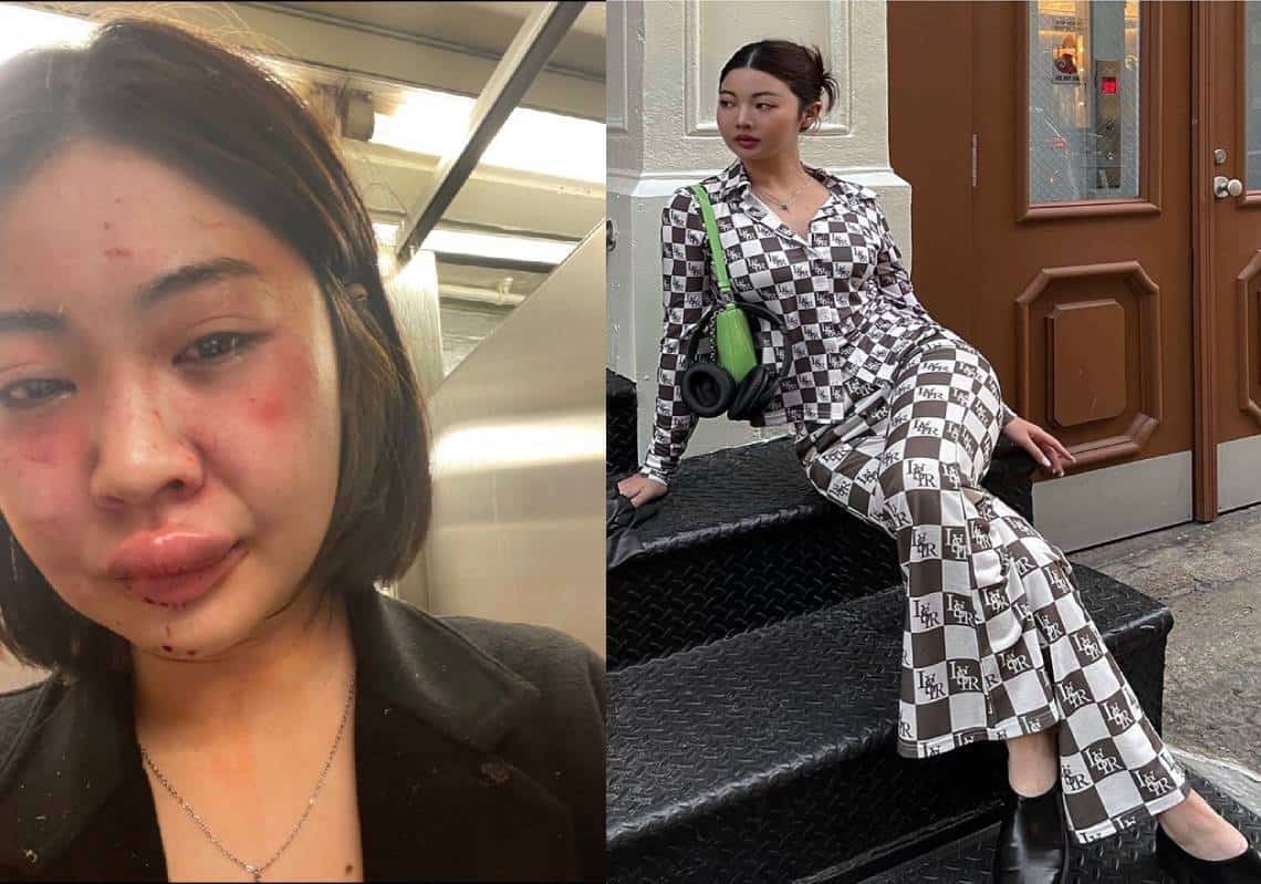 "זה נס שאני נושמת": דוגמנית שהותקפה באכזריות בסאבווי מאשימה את ה-NYPD