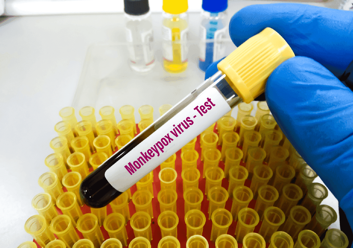 מערכת הבריאות חוששת: מוטציה של אבעבועות הקוף תהפוך אותו לעמיד לתרופה הקיימת