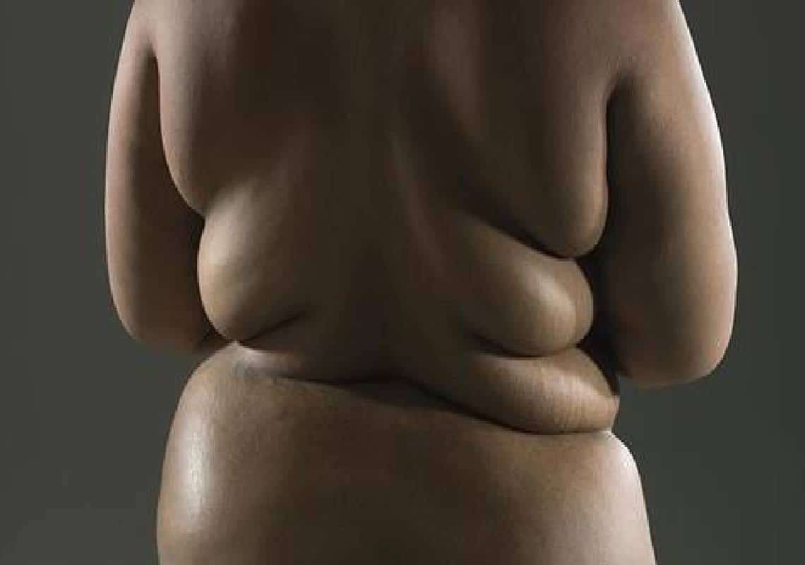 ארגון הבריאות העולמי וה-CDC: "השמנה מגבירה את סיכויי המוות מנגיף הקורונה ב-50 אחוזים"