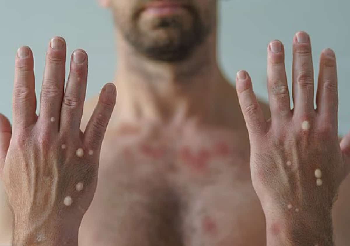 דאגה גדולה בדרום קליפורניה: שלושה גברים נדבקו בזן הקטלני של אבעבועות הקוף