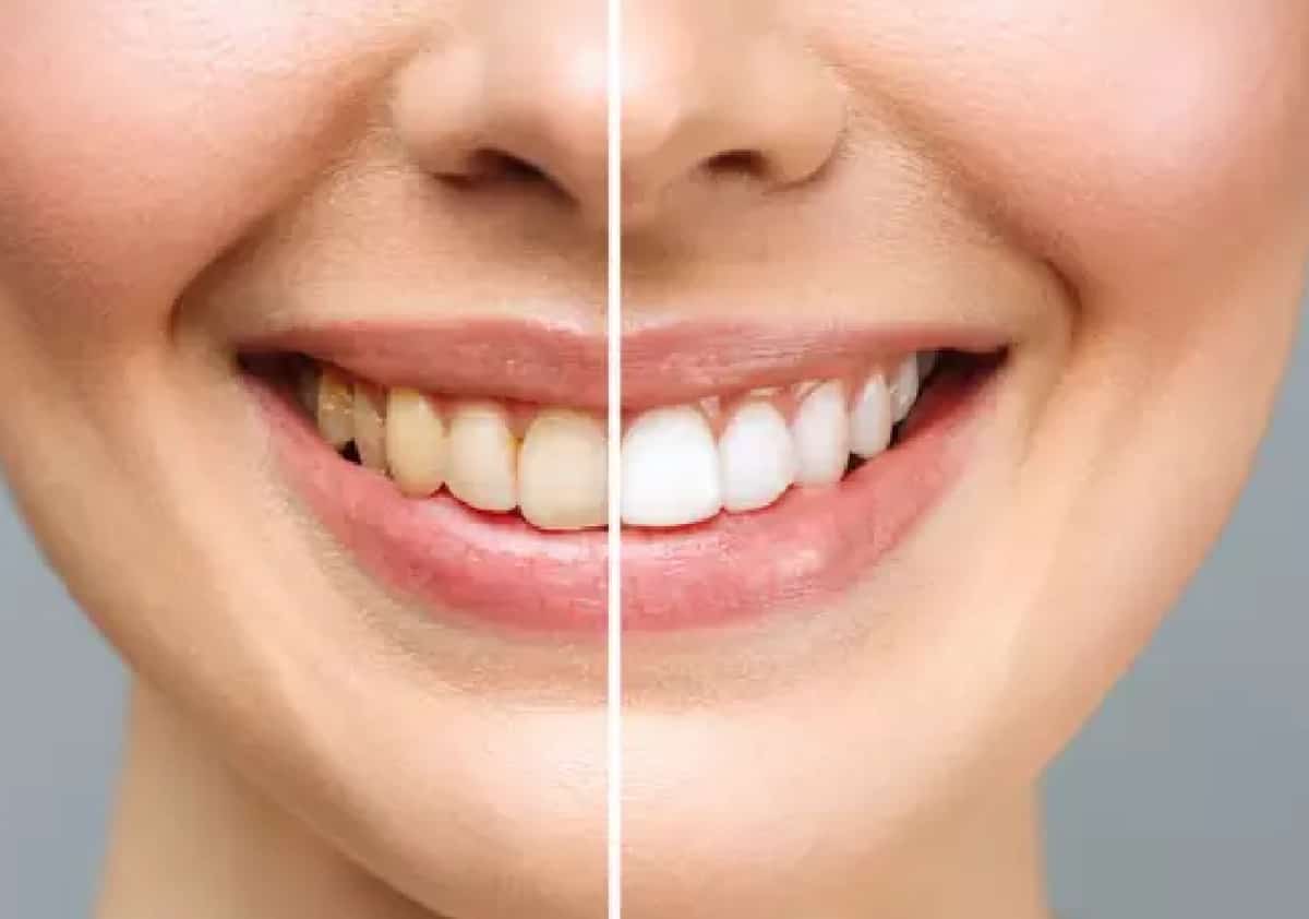 לא רק קפה וסיגריות: המאכלים היומיומיים שמכתימים את השיניים בלי שתשימו לב