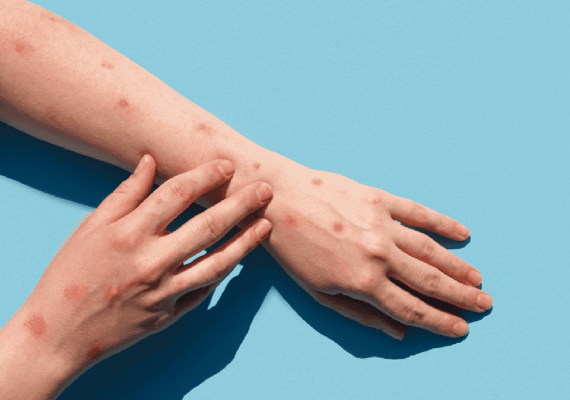 התפשטות אבעבועות הקוף: ה-CDC העלה את רמת הכוננות, ממליץ לעטות מסכות