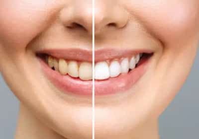 לא רק קפה וסיגריות: המאכלים היומיומיים שמכתימים את השיניים בלי שתשימו לב