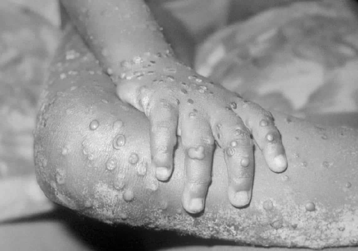 מקרה ראשון של אבעבועות קופים בקליפורניה: "החולה מבודד ומטופל"