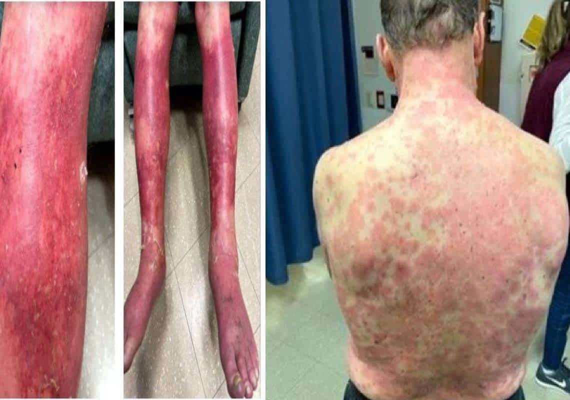 הרופאים הודיעו לו: "תגובה חריגה לחיסון 'ג'ונסון אנד ג'ונסון' גרמה לעורך להתקלף"