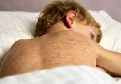 שיא של עשור בקליפורניה: התפרצות חצבת חריגה מדאיגה את הרשויות