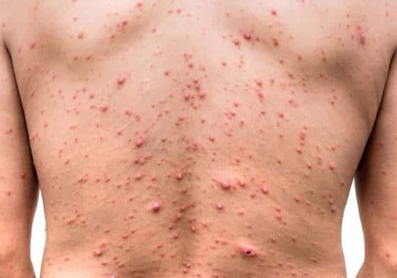 איך שגלגל מסתובב: תלמיד שנאבק בבית המשפט על הרחקתו מביה"ס בגלל שלא חוסן נדבק באבעבועות רוח