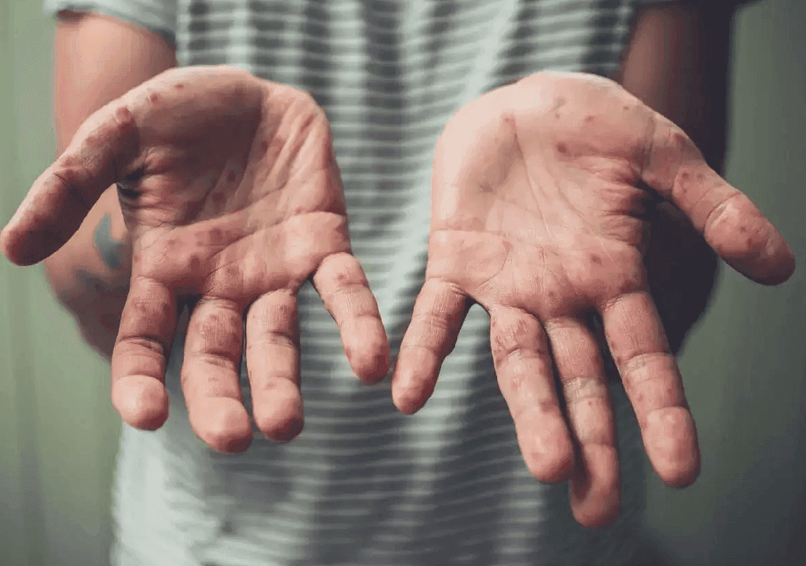 מומחה: התפרצות אבעבועות הקופים - בגלל יחסי מין במסיבות באירופה