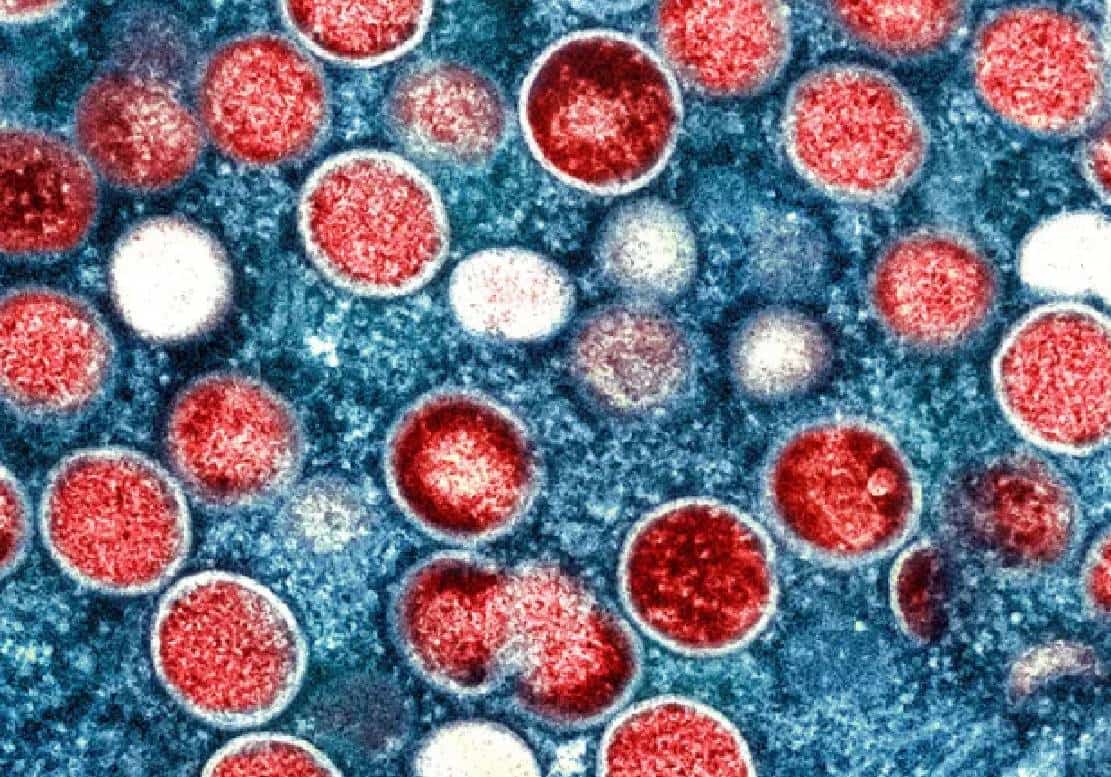 אבעבועות הקופים שונה ל-''mpox'' בשל חששות מגזענות