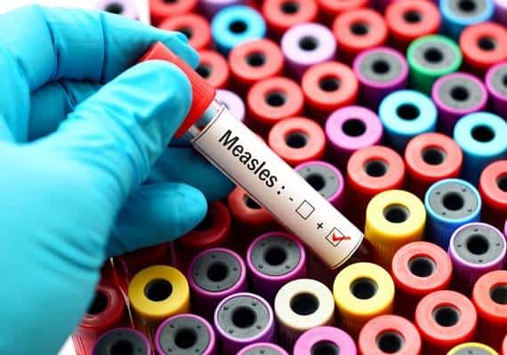 מגיפת החצבת בלוס אנג'לס: אם הייתם במקומות האלה - אתם עלולים להידבק