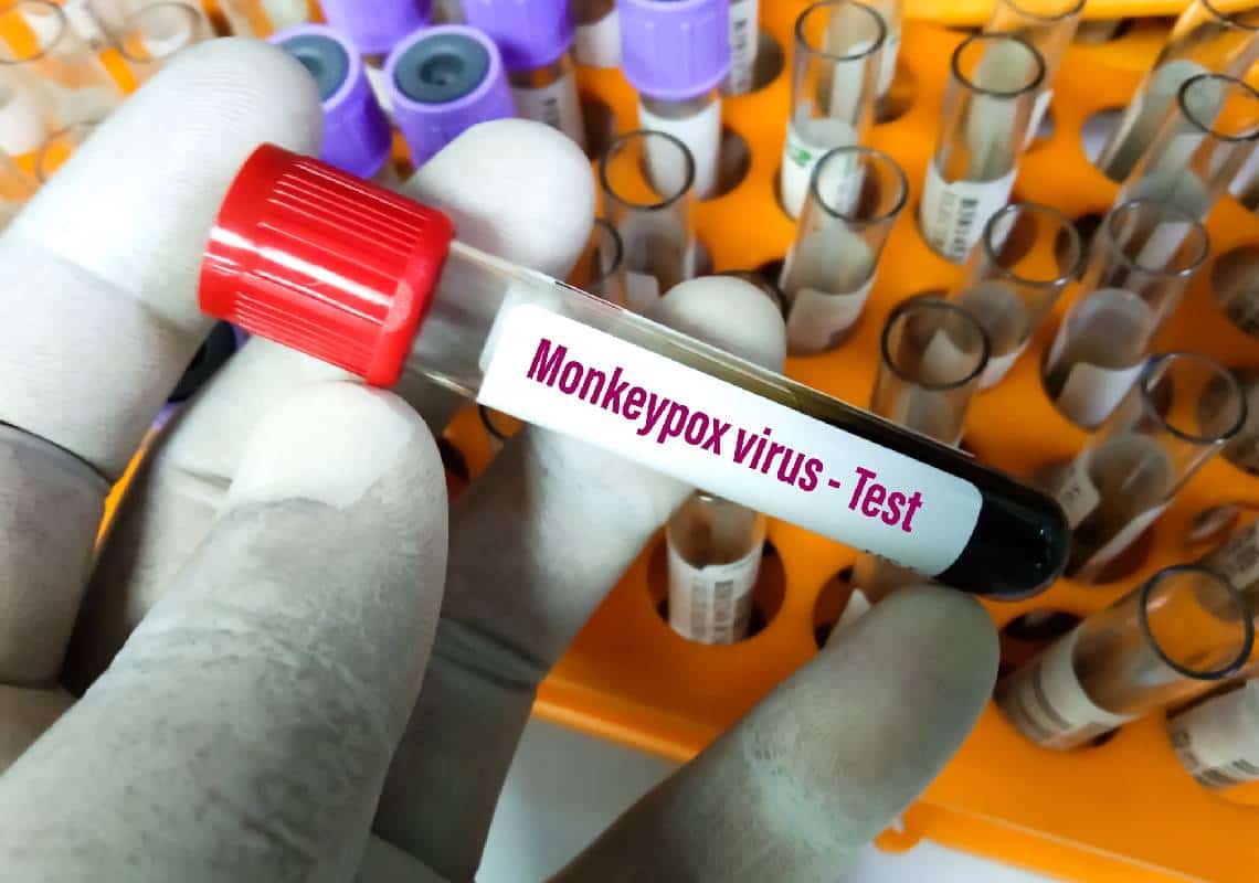 חוקרים: נגיף אבעבועות הקוף עבר מוטציה בקצב "מהיר משציפינו"