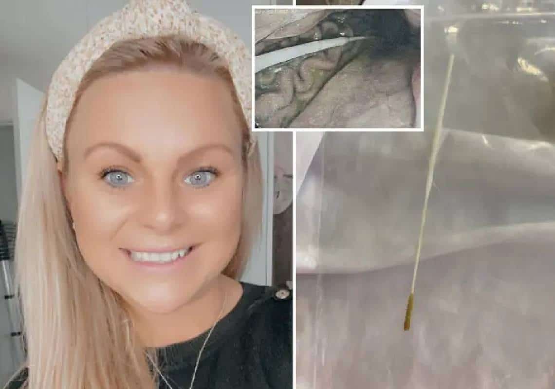 אמא עברה ניתוח מציל-חיים לאחר שבלעה בדיקת קורונה