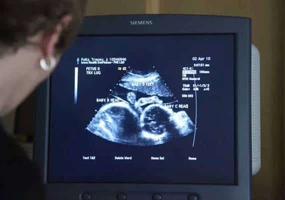 תקדים במדינת איווה: חוק רפובליקני ימנע הפלה מהרגע שלעובר יש דופק