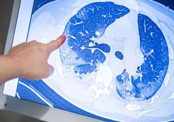 התסמין המסתורי של חולי הקורונה שסותר את הביולוגיה הבסיסית ומבלבל את צוותי הרפואה