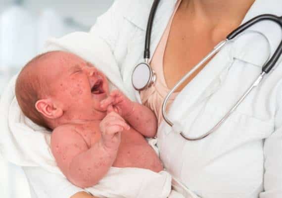 מגיפת החצבת בלוס אנג'לס: תינוק בן פחות משנה וסטודנט אובחנו כחולי חצבת