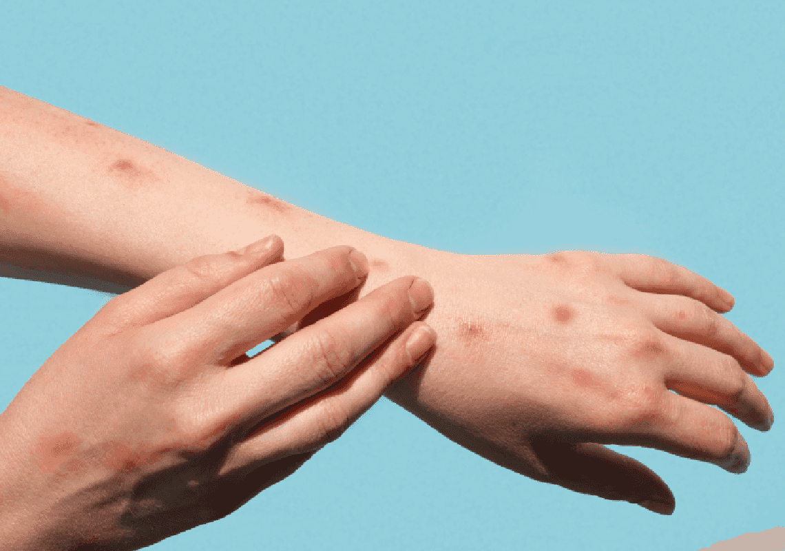 בארצות הברית יש שליש ממקרי אבעבועות הקופים בעולם